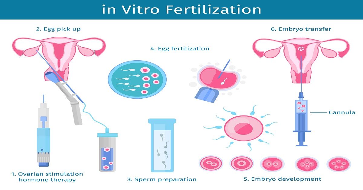 IVF Process | IVF PROCEDURE Step by Step